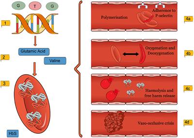 In utero Therapy for the Treatment of Sickle Cell Disease: Taking Advantage of the Fetal Immune System